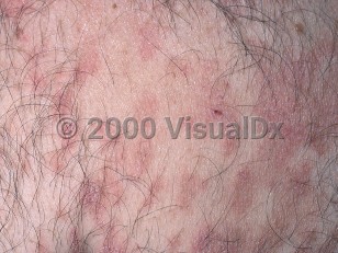 Clinical image of Small plaque parapsoriasis - imageId=322267. Click to open in gallery.  caption: 'A close-up of numerous thin, scaly, pink, and light brown papules and plaques.'