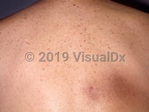 Clinical image of Notalgia paresthetica - imageId=322995. Click to open in gallery.  caption: 'A hyperpigmented patch with an overlying scaly papule at the inferior angle of the scapula.'