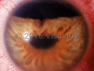 Clinical image of Hyphema - imageId=3239674. Click to open in gallery. 