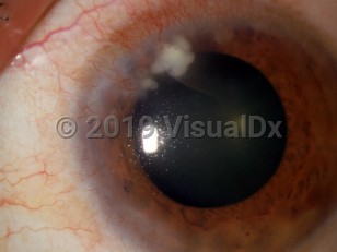 Clinical image of Ocular staphylococcal hypersensitivity - imageId=3242048. Click to open in gallery. 