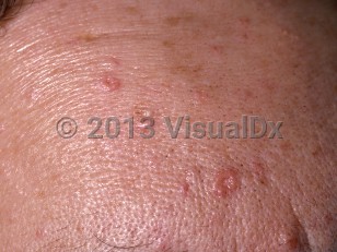 Clinical image of Sebaceous hyperplasia - imageId=325411. Click to open in gallery.  caption: 'A close-up of yellowish and pink umbilicated papules on the forehead.'
