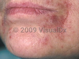 Clinical image of Perioral dermatitis