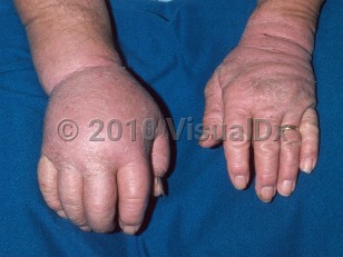 Clinical image of Lymphedema - imageId=327228. Click to open in gallery.  caption: 'Marked edema on the right arm and hand following radiation treatment of the axilla.'