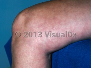 Clinical image of Livedo reticularis - imageId=327523. Click to open in gallery.  caption: 'Reticulate violaceous patches on the leg.'