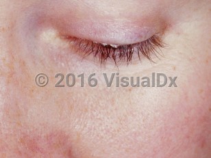 Clinical image of Seborrheic blepharitis - imageId=3275299. Click to open in gallery.  caption: 'Scaling at the eyelid margin.'