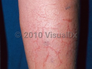 Clinical image of Eczema craquelé - imageId=328387. Click to open in gallery.  caption: 'Polygonal and angulated cracks, each flanked by fine white scales, on the shin.'