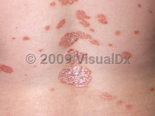 Clinical image of Psoriasis