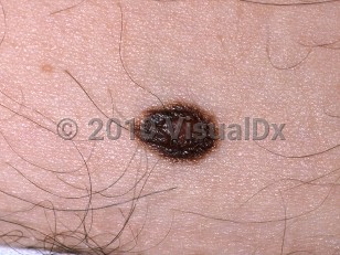 Clinical image of Atypical nevus