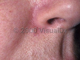 Clinical image of Common acquired nevus - imageId=329792. Click to open in gallery.  caption: 'A flesh-colored papule (intradermal nevus) at the nasal alar crease.'