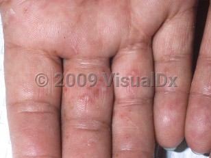 Clinical image of Dyshidrotic dermatitis - imageId=330537. Click to open in gallery.  caption: 'Cloudy vesicles, tiny brown crusts, and some scale on the palmar aspect of the fingers.'