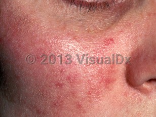 Clinical image of Rosacea - imageId=331974. Click to open in gallery.  caption: 'Erythema, telangiectasias, and few scattered inflammatory papules on the cheek.'