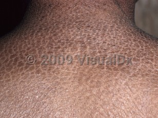 Clinical image of Ichthyosis vulgaris - imageId=333173. Click to open in gallery.  caption: 'A close-up of dry, dark brown scales with a fish skin-like appearance on the posterior neck and upper back.'