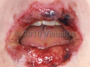 Clinical image of Stevens-Johnson syndrome - imageId=334345. Click to open in gallery.  caption: 'Erosions and hemorrhagic crusting on and around the lips, and some erosions on the tongue, in a case of SJS induced by an anticonvulsant.'