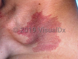 Clinical image of Port-wine stain