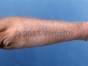 Clinical image of Acquired hypertrichosis lanuginosa