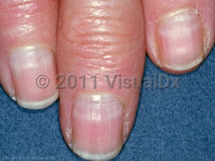 Clinical image of Arsenic poisoning - imageId=3371484. Click to open in gallery.  caption: 'Transverse white bands involving the fingernails. Arsenic exposure occurred 2 and 3 months before presentation (proximal and distal bands, respectively).'
