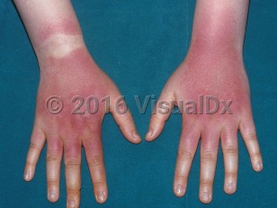 Clinical image of Drug-induced phototoxic reaction - imageId=337847. Click to open in gallery.  caption: 'Deep red patches and plaques on the dorsal wrists, hands, and fingers, sparing the area under the wristwatch, secondary to a medication.'