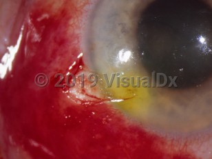 Clinical image of Scleral laceration
