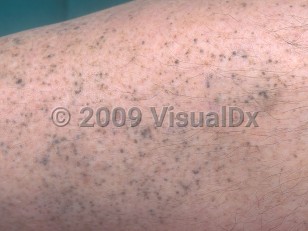 Clinical image of Minocycline drug-induced pigmentation - imageId=340188. Click to open in gallery.  caption: 'A close-up of pinpoint dark gray and black macules.'
