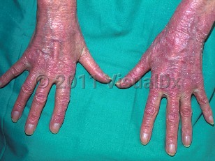 Clinical image of Drug-induced photoallergic reaction - imageId=341044. Click to open in gallery.  caption: 'Widespread scaly and crusted pink plaques on dorsal hands and fingers, secondary to a medication.'