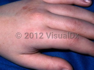 Clinical image of Angioedema - imageId=3427633. Click to open in gallery.  caption: 'Edema of the hand and fingers.'