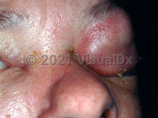 Clinical image of Orbital cellulitis - imageId=3430812. Click to open in gallery.  caption: 'Marked edema and erythema of the upper eyelid with seropurulent discharge at the medial canthus and associated crusting.'