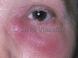 Clinical image of Dacryocystitis - imageId=3431744. Click to open in gallery.  caption: 'An edematous pink plaque at the medial canthus, extending below the lower eyelid.'