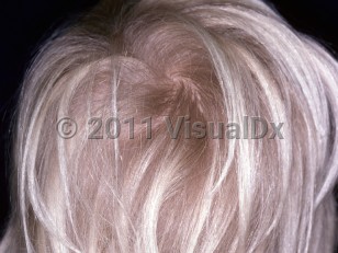 Clinical image of Loose anagen syndrome - imageId=3448064. Click to open in gallery.  caption: 'A young female child with light-colored hair and mild hair thinning.'