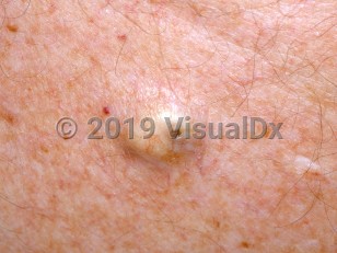 Clinical image of Epidermoid cyst