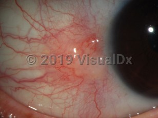 Clinical image of Nodular scleritis - imageId=3511295. Click to open in gallery. 