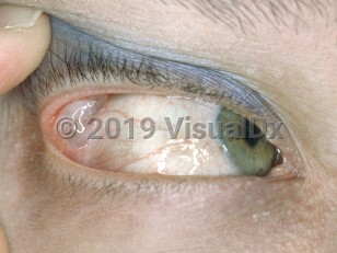 Clinical image of Lacrimal gland cyst - imageId=3520291. Click to open in gallery.  caption: 'A translucent mass at the upper outer lid.'