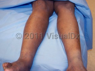 Clinical image of Deep vein thrombosis