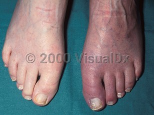 Clinical image of Ergotism - imageId=352707. Click to open in gallery.  caption: 'A dusky appearance on the dorsal left foot and toes, secondary to ergotamine.'