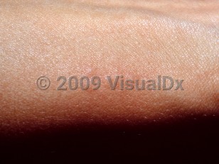Clinical image of Puss caterpillar sting - imageId=3529419. Click to open in gallery.  caption: 'A linear array of edematous and faintly erythematous papules on the arm.'