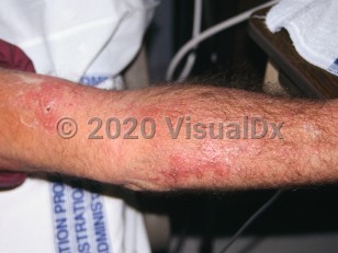 Clinical image of Protothecosis - imageId=3529643. Click to open in gallery.  caption: 'Crusted, erythematous papules and plaques on the arm.'