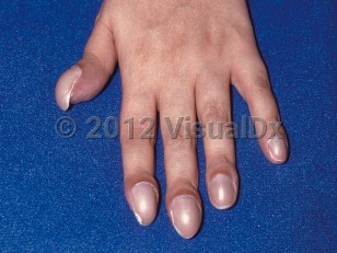 Clinical image of Clubbing of nails - imageId=35530. Click to open in gallery.  caption: 'Increased transverse and longitudinal curvature of the nails with hyperthrophy of distal digits in a patient with polycythemia vera.'