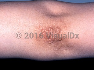 Clinical image of Tuberous xanthoma