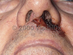 Clinical image of Trigeminal trophic syndrome - imageId=357852. Click to open in gallery.  caption: 'An ulcer with overlying and surrounding hemorrhagic crust at the nostril.'