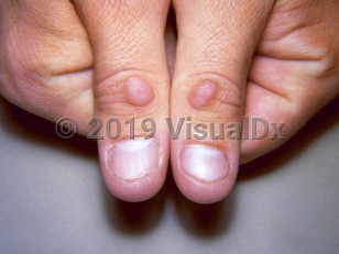Clinical image of Knuckle pads - imageId=35819. Click to open in gallery.  caption: 'Pink, scaly papules over the distal interphalangeal joints.'