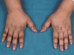 Clinical image of Cushing syndrome - imageId=358243. Click to open in gallery.  caption: 'Velvety hyperpigmented plaques (acanthosis nigricans) over the knuckles.'