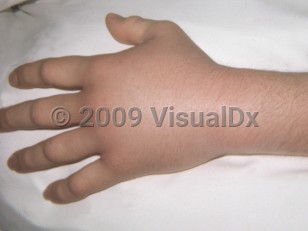 Clinical image of Lizard envenomation - imageId=3585332. Click to open in gallery.  caption: 'Marked edema and subtle erythema on the hand and wrist.'