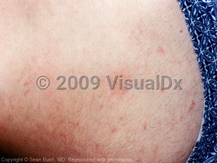 Clinical image of Centipede envenomation - imageId=3590859. Click to open in gallery.  caption: 'Erythematous papules and thin plaques, some linear in configuration, on the flank.'