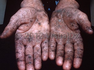 Clinical image of Arsenical keratosis - imageId=362170. Click to open in gallery.  caption: 'Multiple hyperkeratotic papules coalescing to form cobblestone-like plaques on the palms and fingers.'