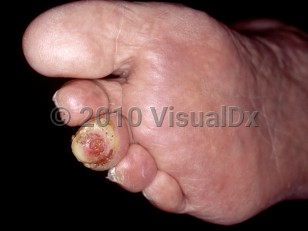 Clinical image of Diabetic neuropathy