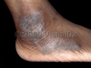 Clinical image of Lichen simplex chronicus - imageId=3644043. Click to open in gallery.  caption: 'Lichenified, scaly, hyperpigmented plaques on the lateral foot and ankle.'