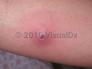 Clinical image of CA-MRSA skin infection