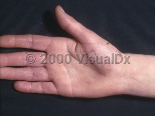 Clinical image of Acrocyanosis - imageId=367116. Click to open in gallery.  caption: 'A violaceous tinge to the fingers.'