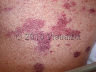 Clinical image of Strongyloidiasis