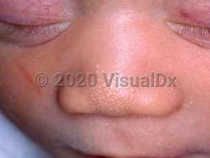 Clinical image of Sebaceous hyperplasia in newborn