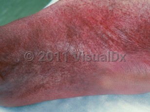 Clinical image of Drug-induced non-palpable purpura - imageId=369027. Click to open in gallery.  caption: 'Showers of discrete and confluent petechiae and purpura on the foot.'